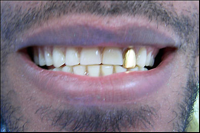 dentures2