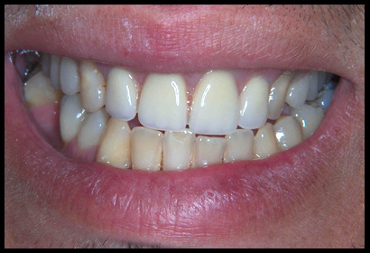 upperpartial_1a